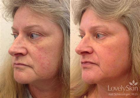 Rosacea Before And After
