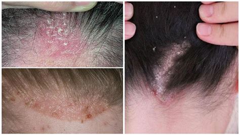 Hair mite in people's heads - symptoms and treatment