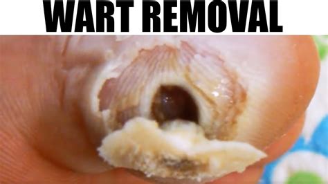 Plantar Wart Removal Pictures