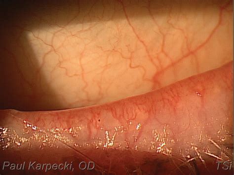 Telangiectasia Eyelid