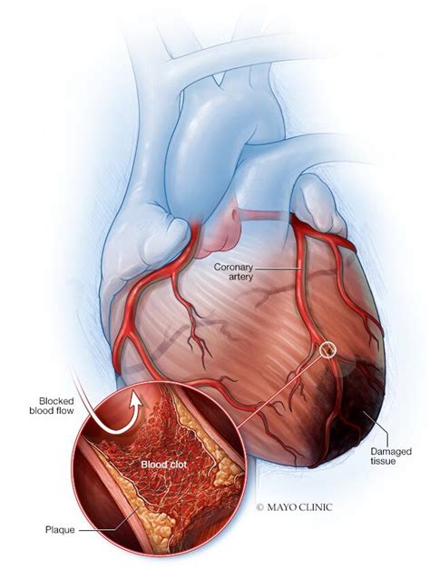 Myocardial Infarction Symptoms