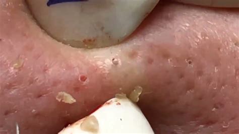 Pimple popping videos 2022 blackheads youtube - YouTube