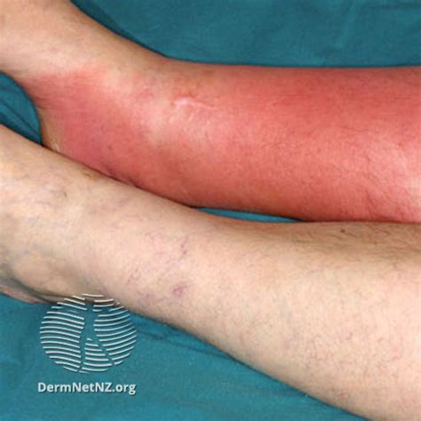 Cellulitis: Clinical Presentation, Differential Diagnosis and Treatment - PcMED Project