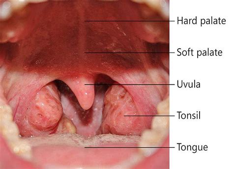 Palatine Tonsil - Emedicodiary