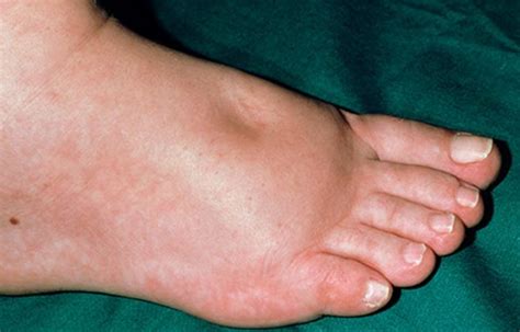 What Causes Swollen Feet In Diabetes?