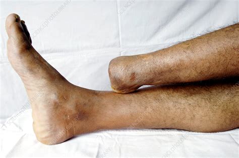 Amputated foot - Stock Image - C054/6801 - Science Photo Library