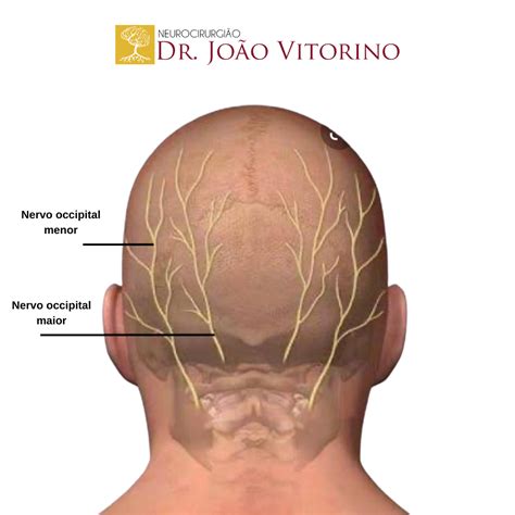 Neuralgia occipital - Neurocirurgião em São Paulo - Especialista em Tumores Cerebrais