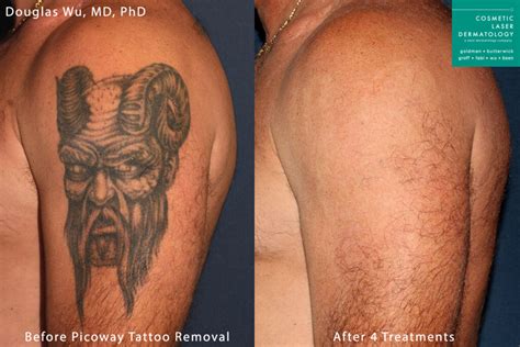 Laser Tattoo Removal Prices South Africa - Second Skin Tattoo