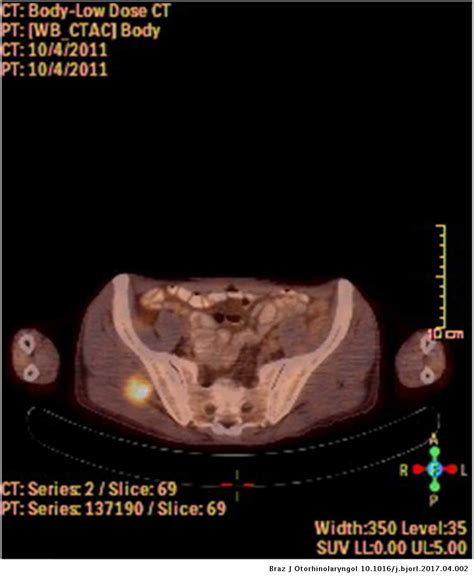 Gluteus medius muscle metastasis of squamous cell carcinoma of larynx: a rare case | Brazilian ...