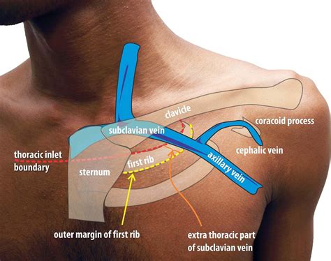 Permanent Pacemaker (PPM, ICD, CRT) — Golden Shutter Films