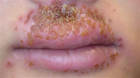 Infected Eczema: Pictures, Treatment, Removal, and More