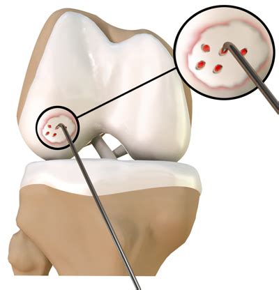 Chondroplasty Denver CO | Cartilage Repair Surgery Denver CO