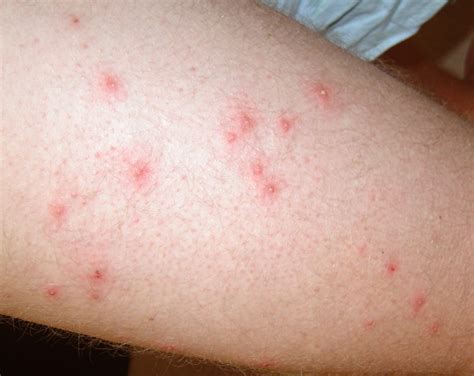 Will Hot Tub Folliculitis Go Away On Its Own at Michael Smith blog