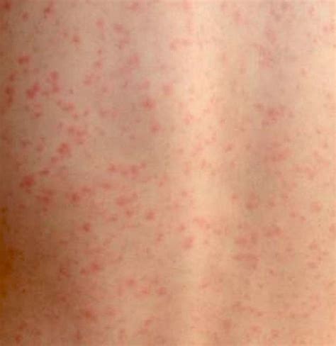 Scarlet fever: Causes, symptoms, treatment, and complications