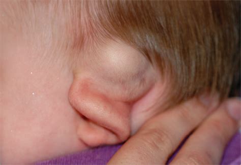 Glial Choristoma of the Temporal Bone in a 7-Month-Old Infant | Head and Neck Cancer | JAMA ...