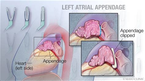 To have or not to have... your left atrial appendage closed