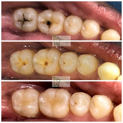 TOOTH CAVITY or TOOTH DECAY is the most common ora