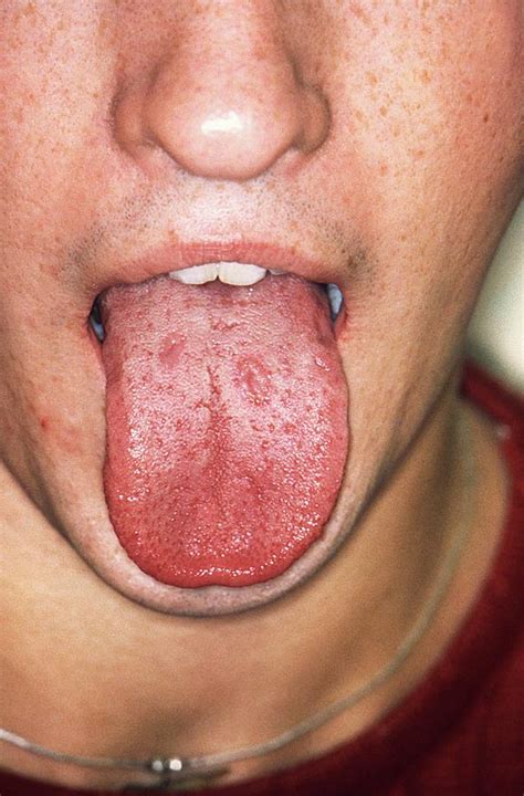 Syphilis In The Mouth Photograph by Cdc/science Photo Library - Pixels