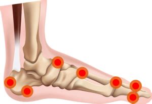 Bone Spur Diagnosis and Treatment Doctor - Moore Foot & Ankle