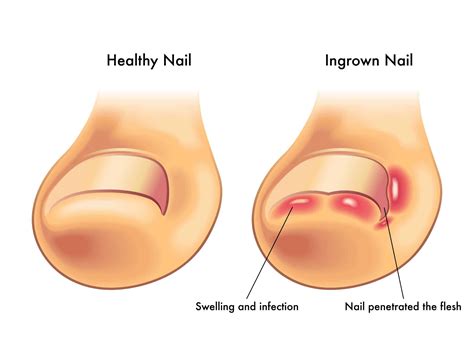 Ingrown Toenails Do I Need Surgery? - A Step Ahead Foot + Ankle Care