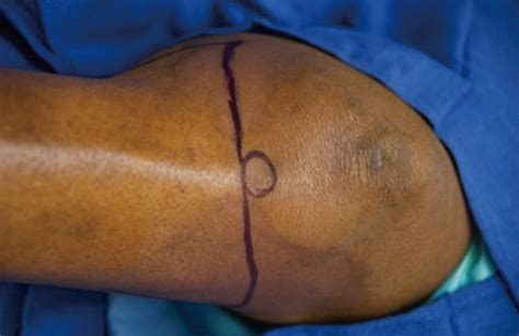 Knee disarticulation case A 57-year-old female with history of diabetes ...