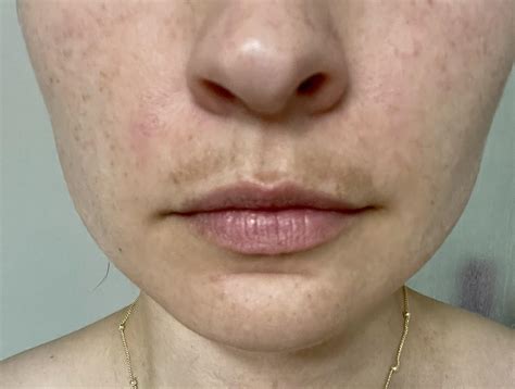 This melasma mustache has got to go : r/30PlusSkinCare