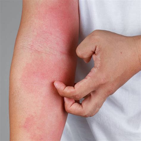 Phototherapy for Eczema | Blog - SolaWave