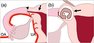 Schematic view showing the normal interstitial portion of the fallopian... | Download Scientific ...