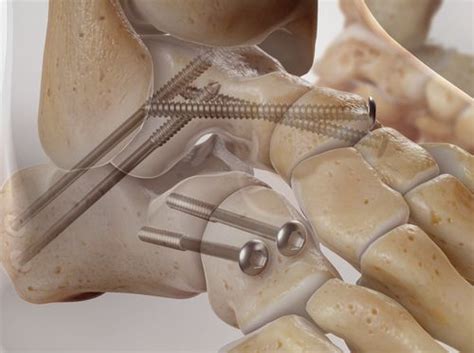 Video - Triple Arthrodesis - HealthClips Online