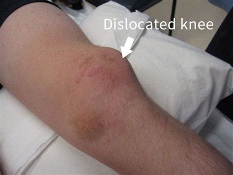 Dislocated Knee: Symptoms, Causes, Treatment By Knee Braces