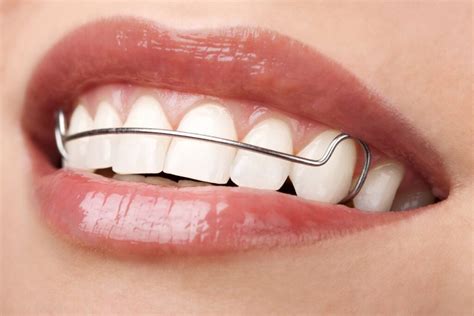 Permanent Retainer vs. Removable Retainer: Learn the Difference!