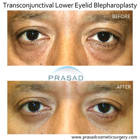Is Lower Blepharoplasty Permanent? | Dr. Prasad Blog