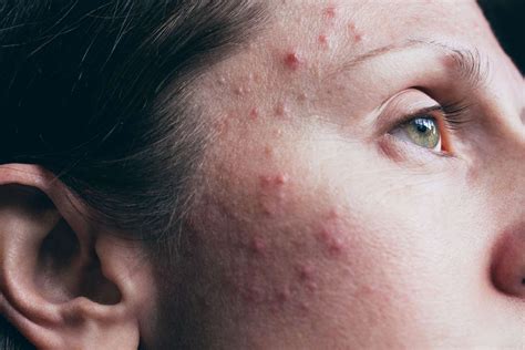 Acne Vulgaris: Types, Symptoms, Causes, Treatment, and More