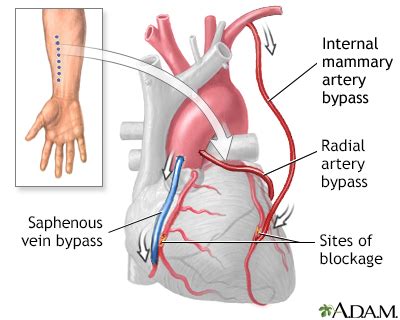 In-Depth Reports - Heart bypass surgery - series