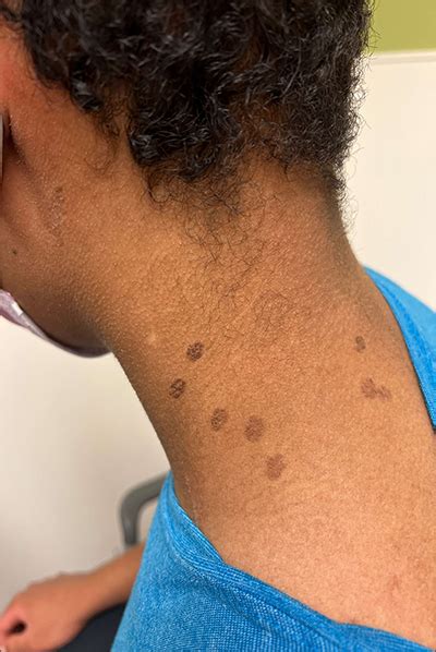 Teen with hyperpigmented skin lesions | MDedge Family Medicine