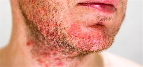 Folliculitis | Dermatology and Skin Health - Dr. Mendese