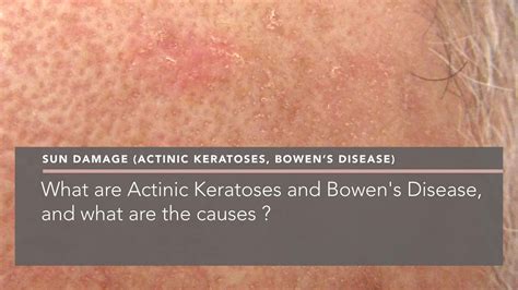 Actinic Keratosis Pictures Causes And Prevention - vrogue.co
