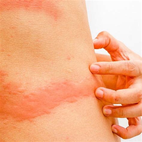 Know About The 5 Types Of Skin Rashes | Images and Photos finder