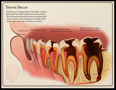 Medical Sundries: Tooth decay