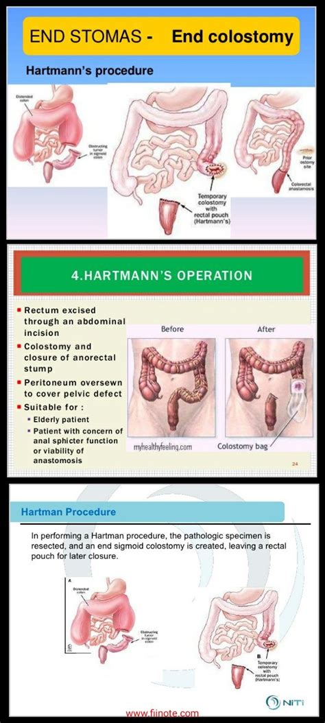 Hartman's operation - End Colostomy ... #Hartman 【 Note : Leaving a Rectal pouch for later ...