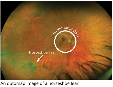 Optomap Retinal Imaging – Savannah Family Eye Care | Savannah, GA