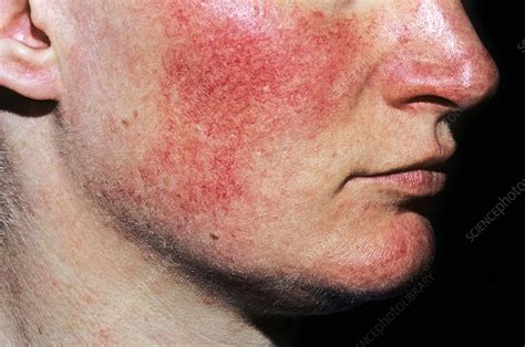 Ariboflavinosis skin rash - Stock Image - C021/3559 - Science Photo Library