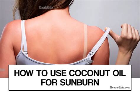 How To Use Coconut Oil For Sunburn Relief?