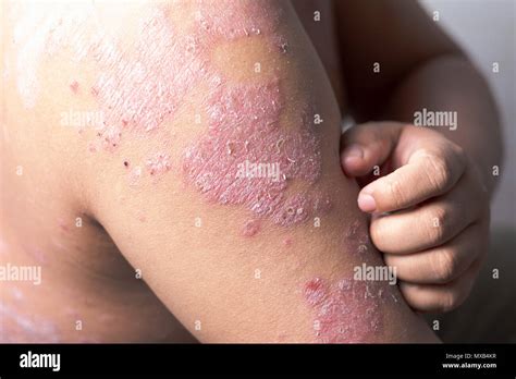 Prickly heat skin disease hi-res stock photography and images - Alamy