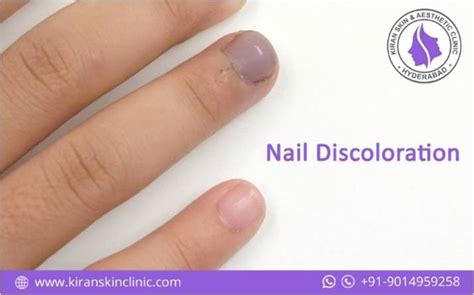 Nail Discoloration Treatment in Hyderabad | Kiran Skin Clinic