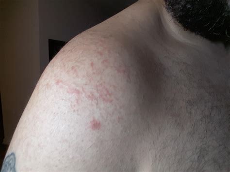 Is this eczema or some type of other rash? (Image) : r/Accutane