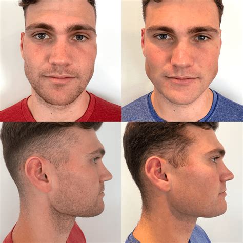 Mewing Exercises Result Of A Jawline Reshape 16250461 - vrogue.co