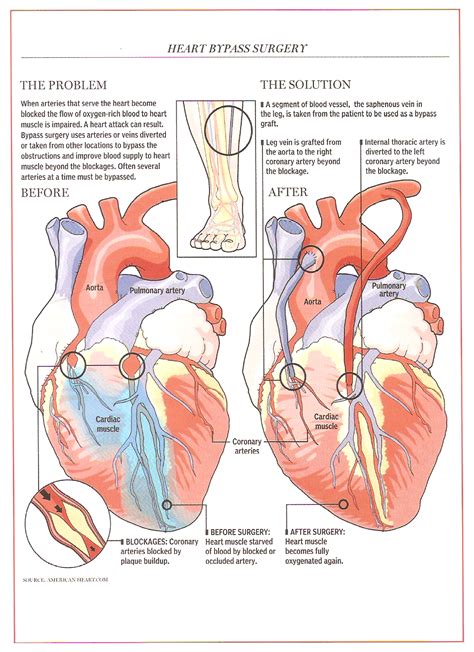 Pin de nonas arc en Anomalous Origin of the Left Coronary (ALCAPA)