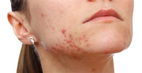 How to Fade Acne Scars Fast, Naturally, Diminish Acne Marks, Permanently at home