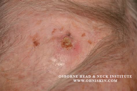 Squamous Cell Carcinoma Skin Cancer Surgery